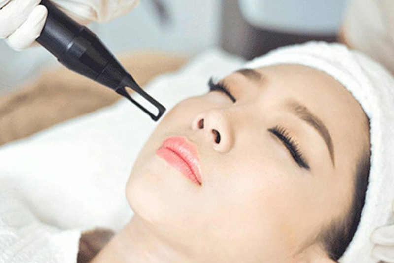 Trị mụn bằng laser là gì?